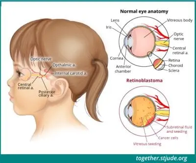 Nutrition in retinoblastoma