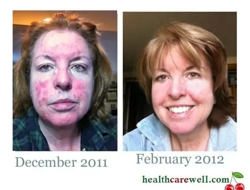 Nutrition with rosacea