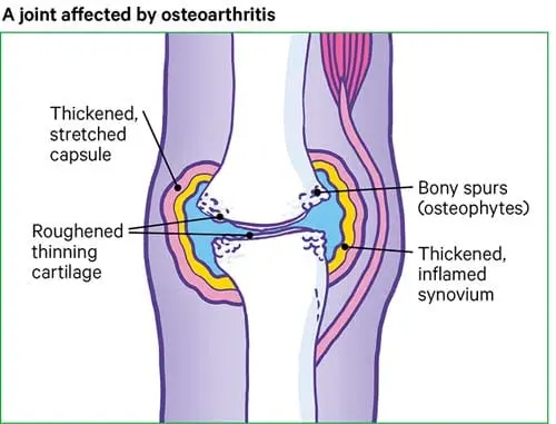 Osteoarthritis