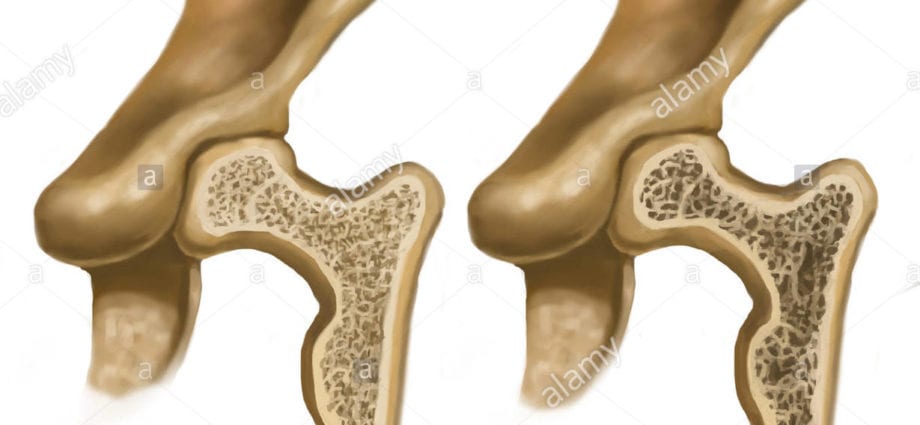 Osteohondropatija