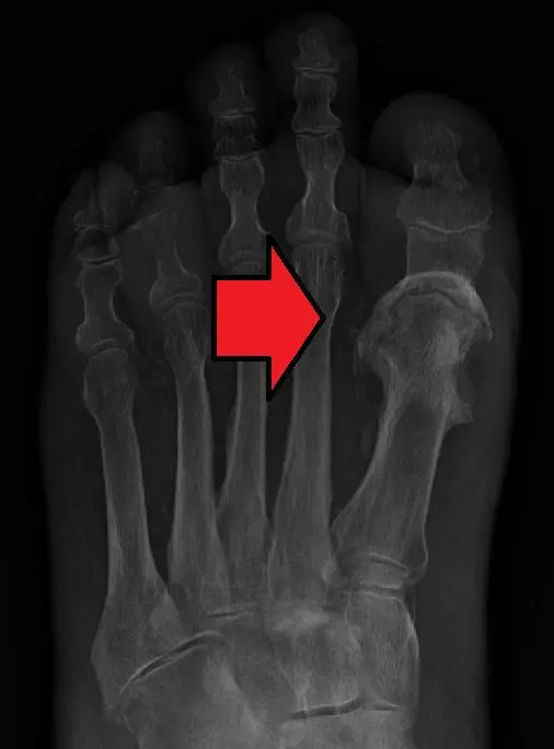 Osteomyelitis