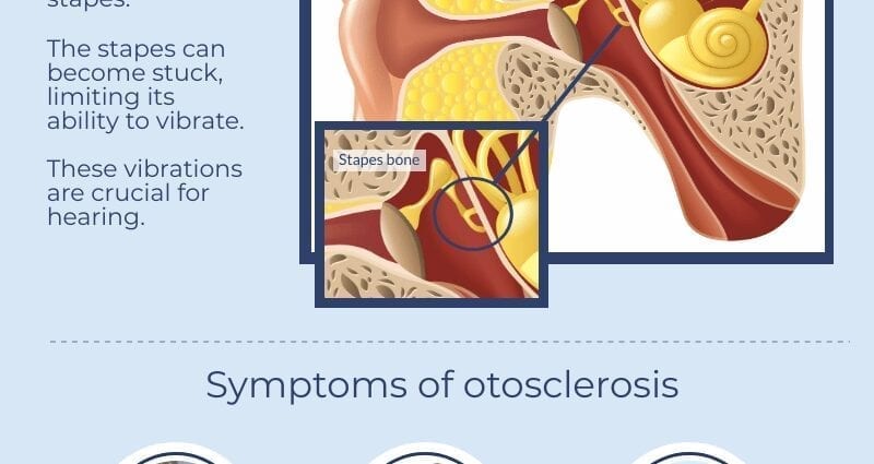 Otosklerose