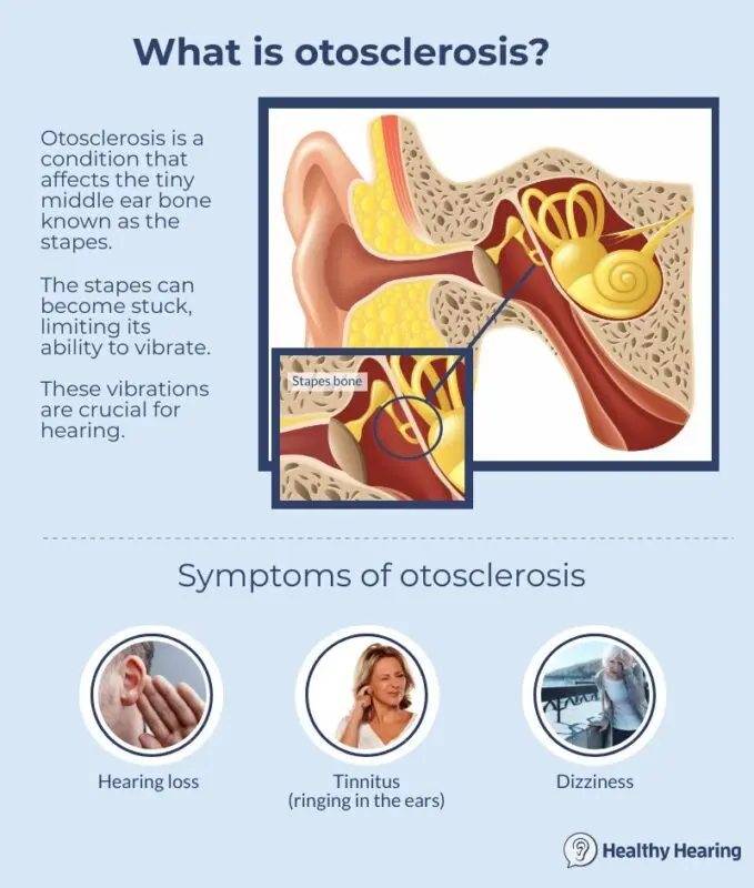 Otosclerosis