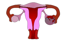 Apoplexie ovarienne