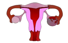 Ovarian apoplexy