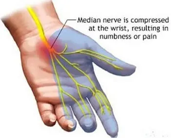 Paresthesia