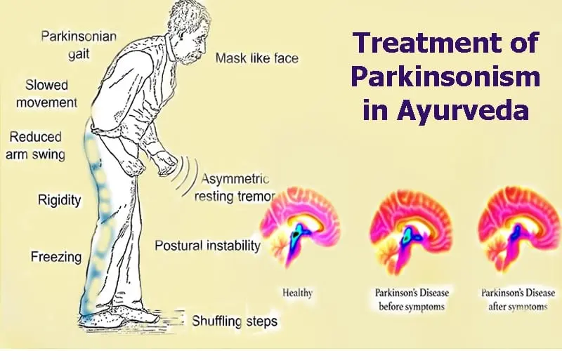 Parkinsonism