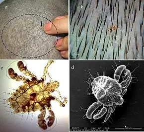 Pediculosis