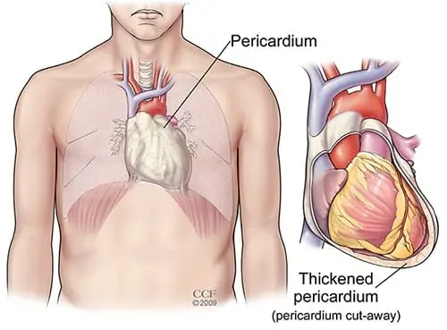 Pericarditis