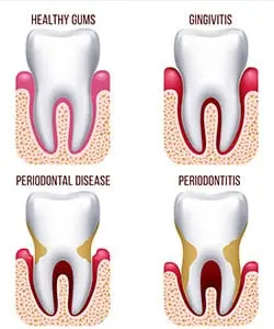 Periodontal disease