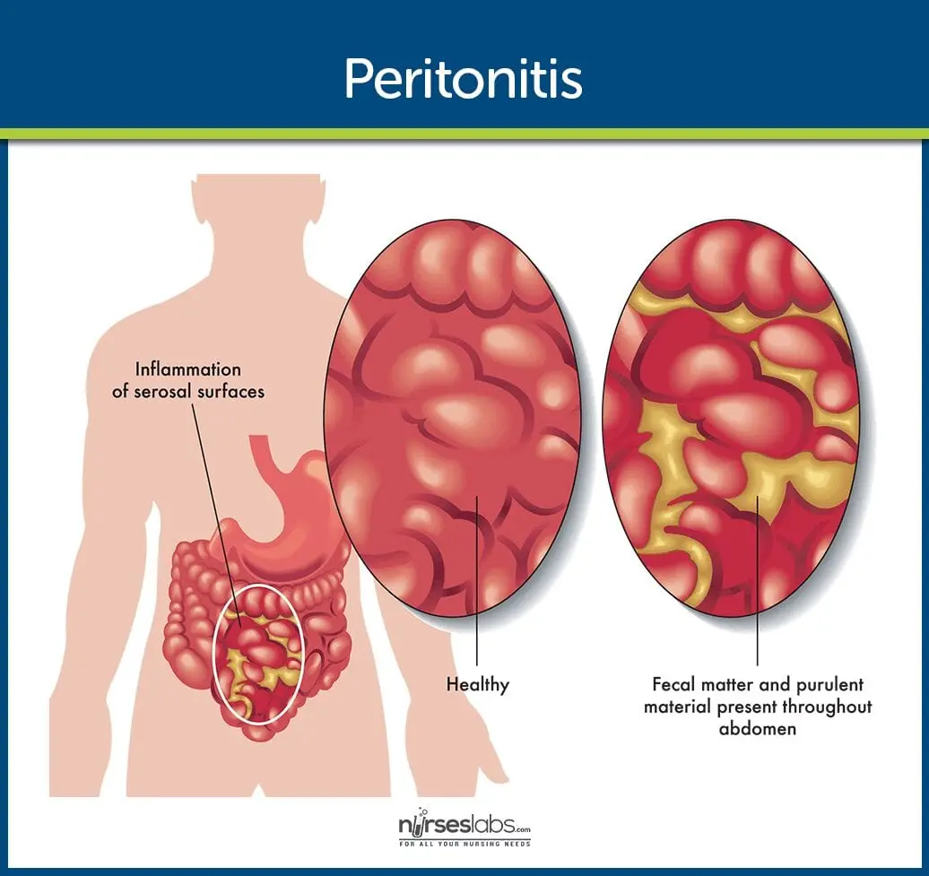 Peritonitis