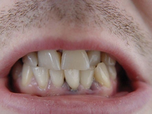 רעל על השיניים: המזונות המזיקים ביותר באמייל השן