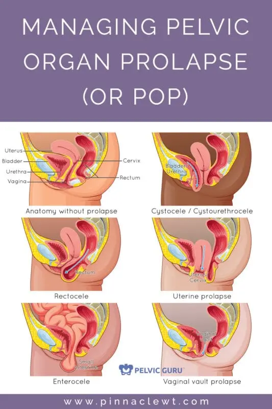 Prolapse