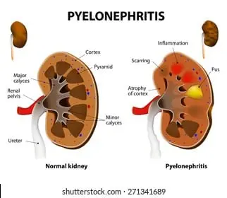 pyelonephritis