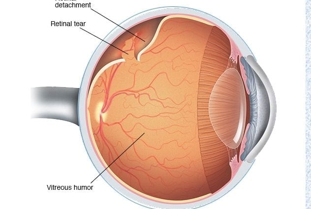 Disinsertion retina