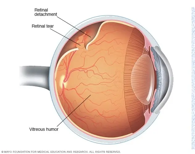 Retinal disinsertion