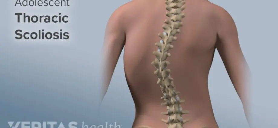 Scoliosis