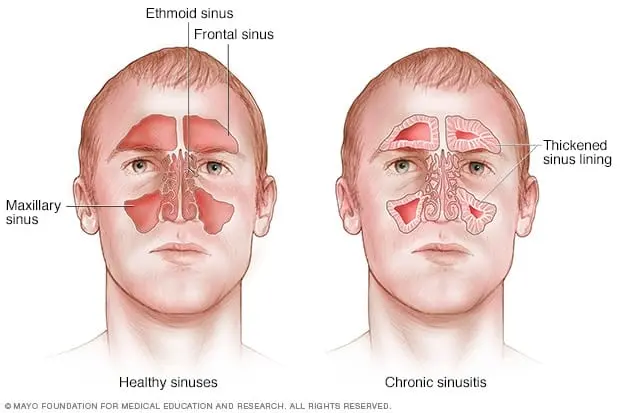 Sinusitis