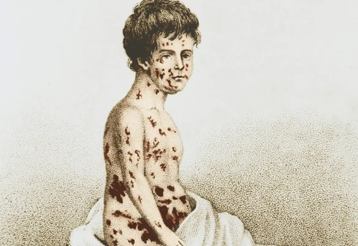 Smallpox