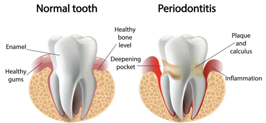 lefu la periodontitis