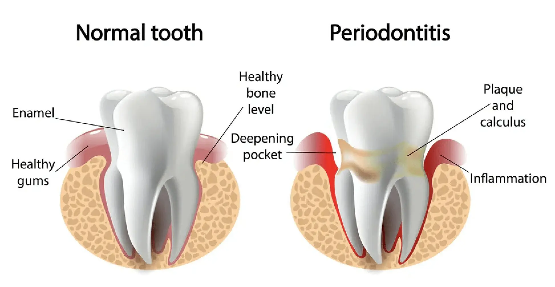 Periodontitis