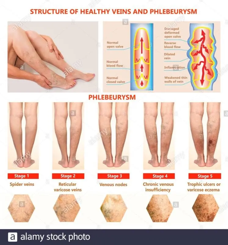 Thrombophlebitis