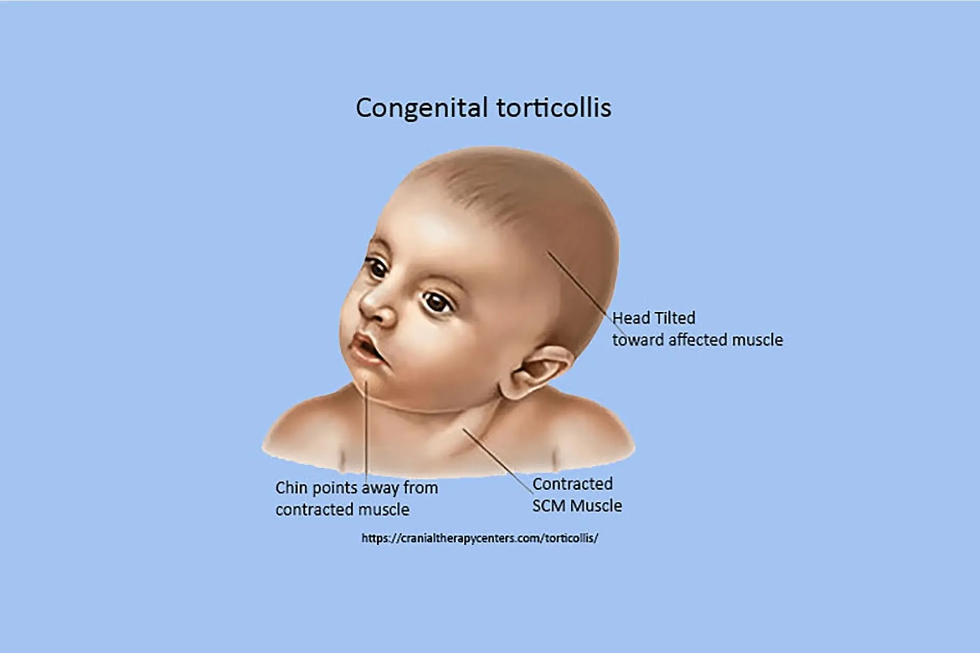 Torticollis