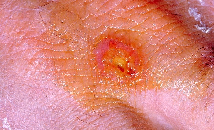 tularemia