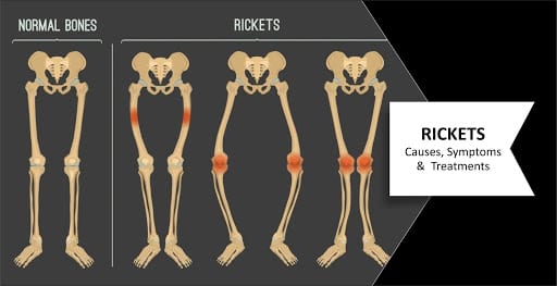Nutrition for rickets