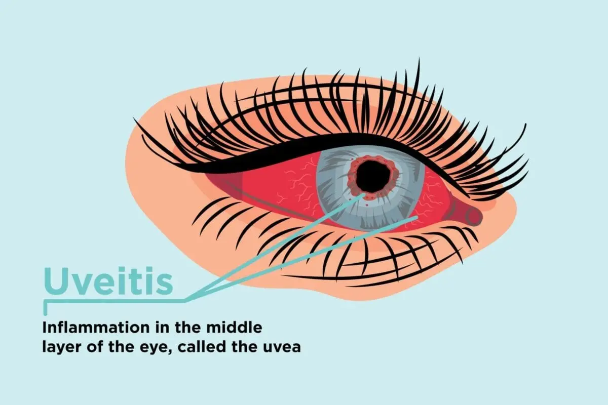 Uveitis