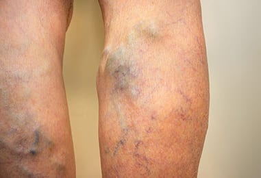 Varicose veins. A disease that stretches from antiquity