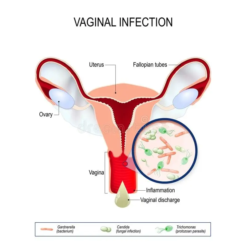 Vulvovaginitis