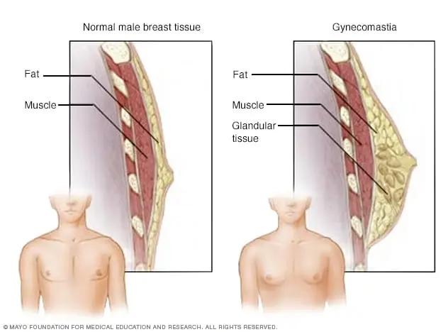 What makes breasts grow in men and how to deal with it?