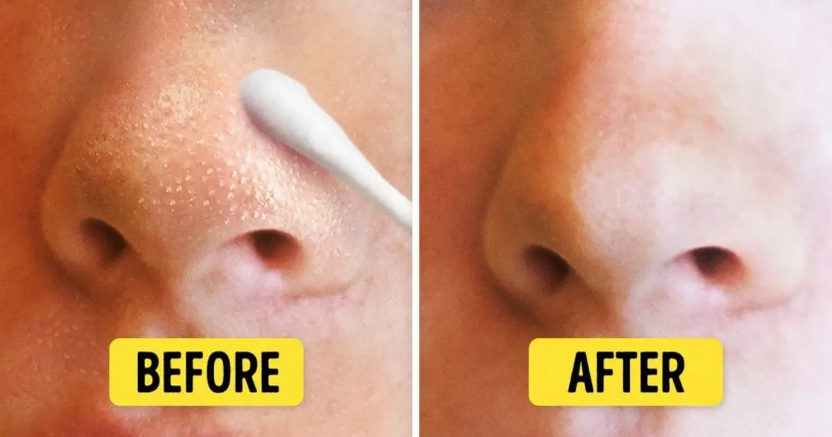 Black dots or comedones on the nose: ways to get rid of
