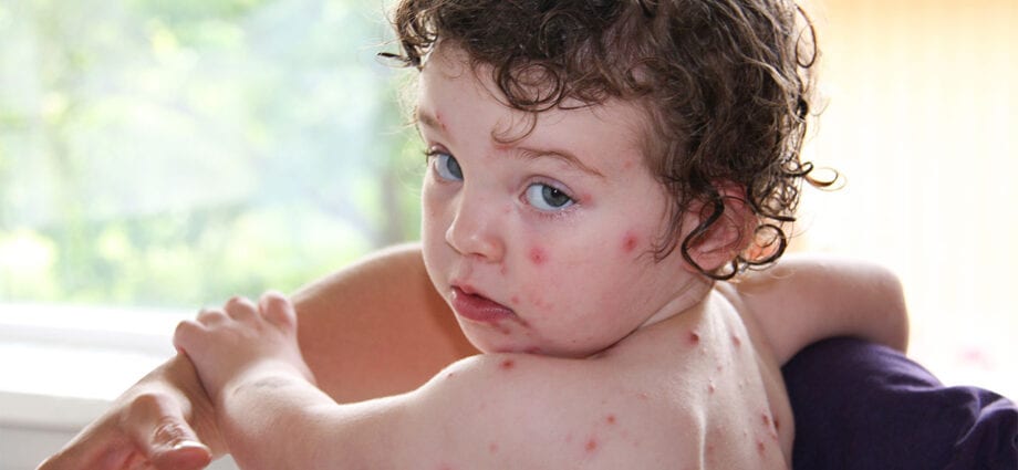 Chickenpox in children