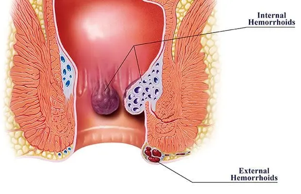 Cons of a Sedentary Lifestyle or How to Avoid Hemorrhoids