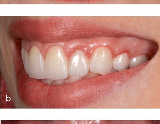 دندان های سالم - کلید شکل ظاهری لاغر