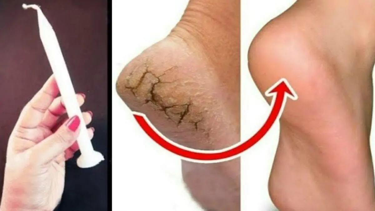 How to get rid of cracked heels