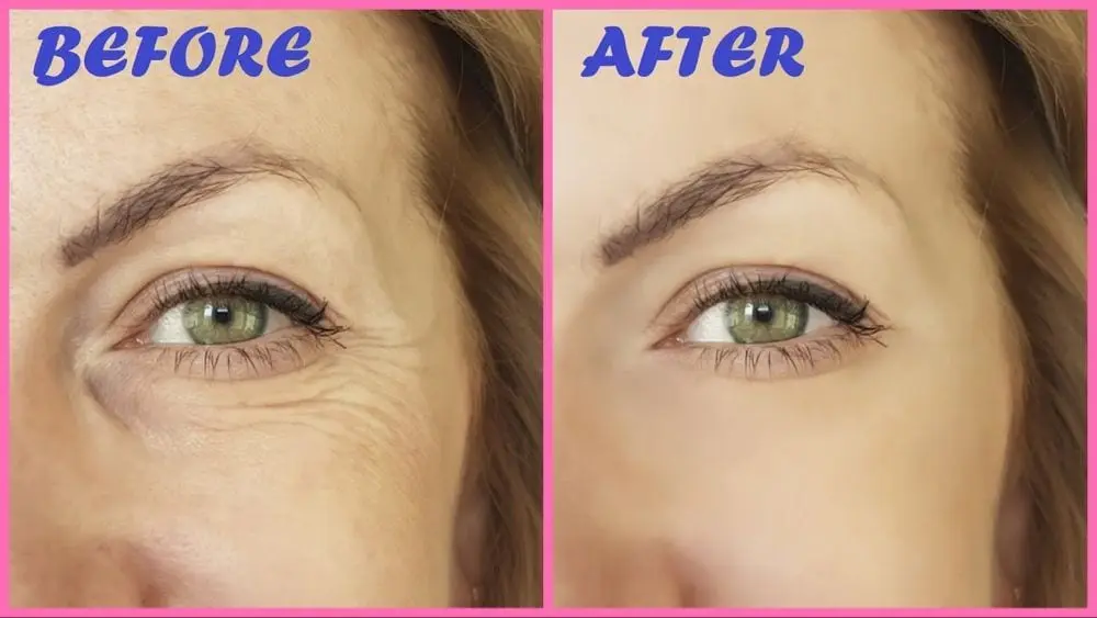 How to get rid of wrinkles under the eyes