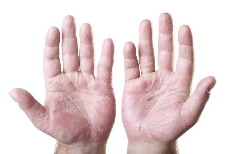 If the skin of the hands is dry