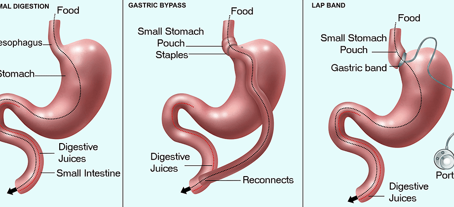 Surgical methods of weight loss