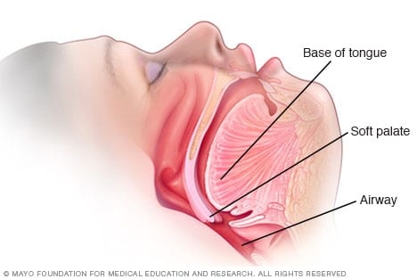 What is snoring and what causes it?