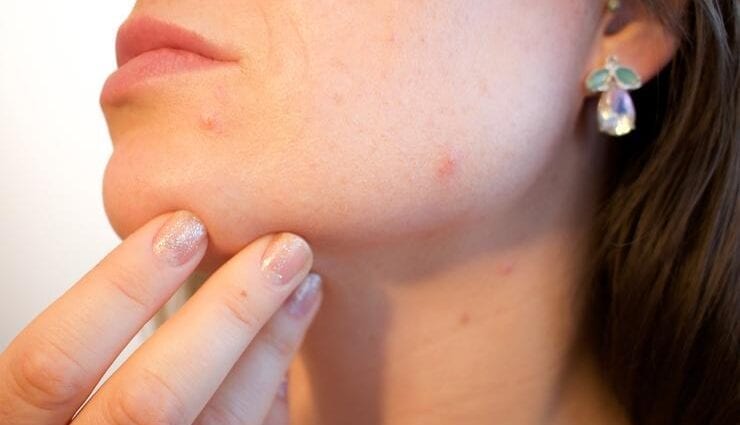 Produits qui aideront avec l'acné