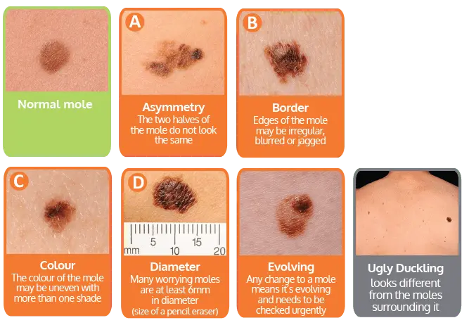 10 symptoms of skin cancer