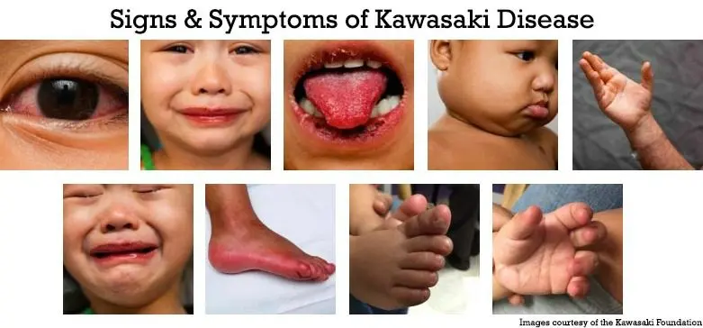 10 things to know about Kawasaki disease