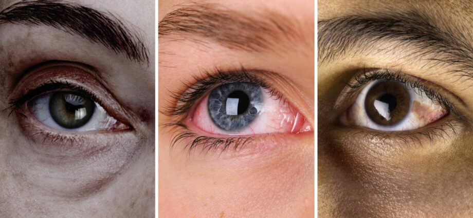 眼睛会告诉你的15个健康问题