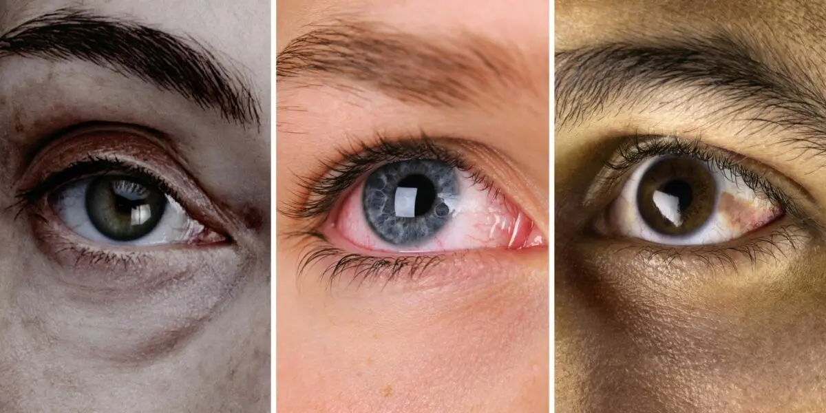 15 health problems your eyes can tell you