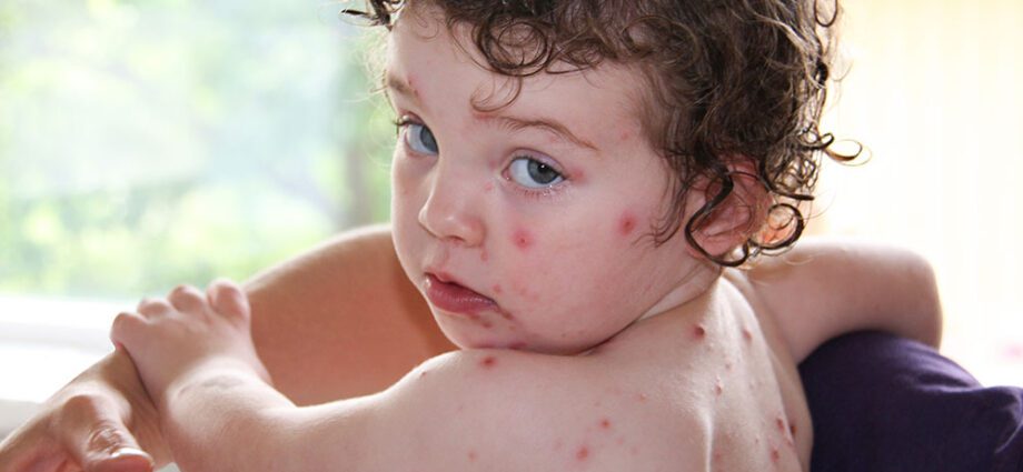 4-year-old girl was left disabled after having had chickenpox