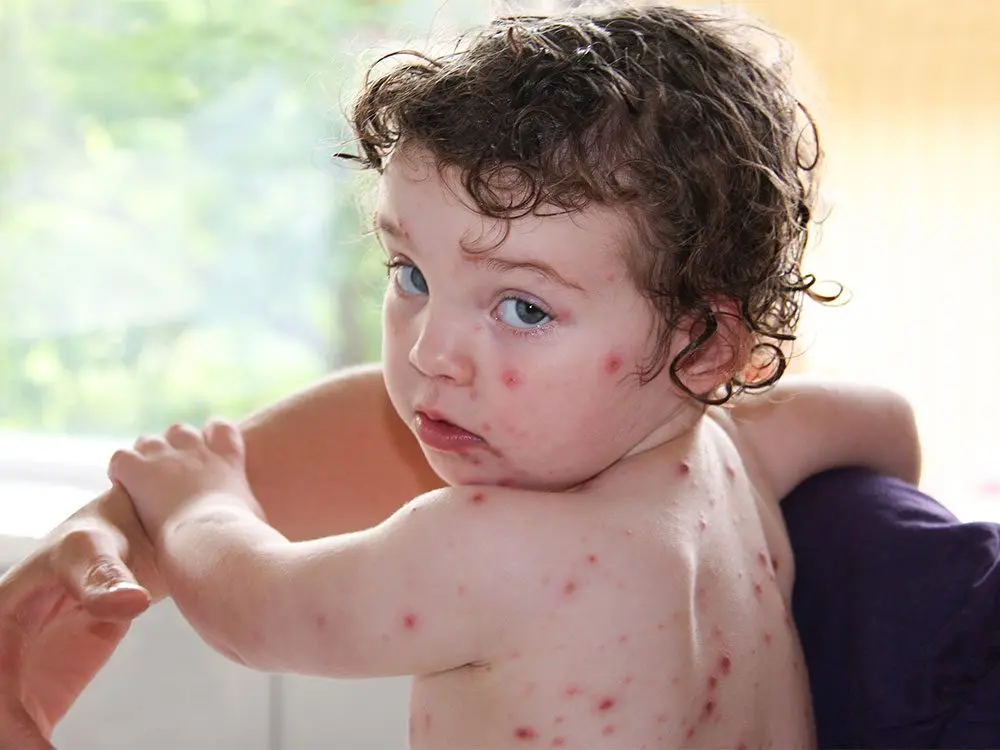 4-year-old girl was left disabled after having had chickenpox