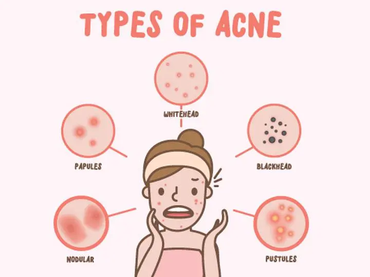 7 types of acne: causes and treatments